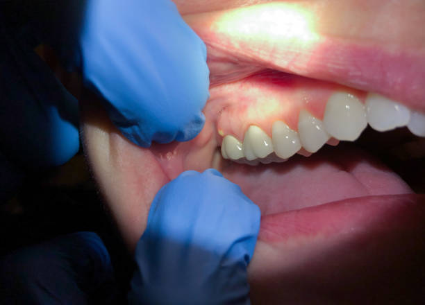 Best Emergency Denture Repair in Daleville, IN
